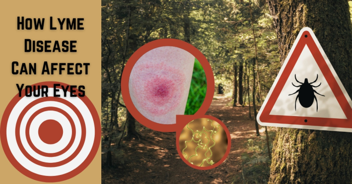 How Lyme Disease Can Affect Your Eyes